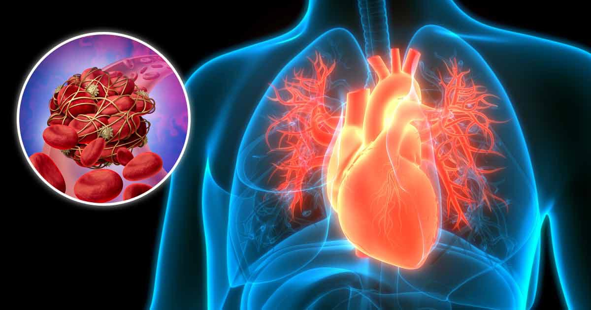 I coaguli di sangue possono essere la causa principale di tutte le malattie cardiache