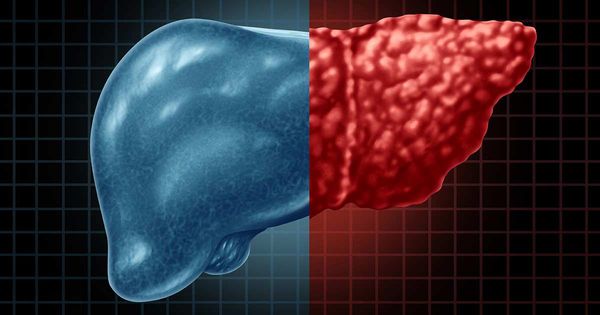 I danni al fegato sono un'epidemia in crescita