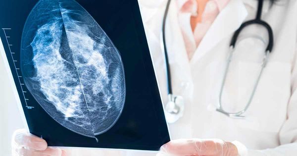 Il 50% delle donne ha ottenuto un risultato falso positivo per la mammografia dopo 10 anni