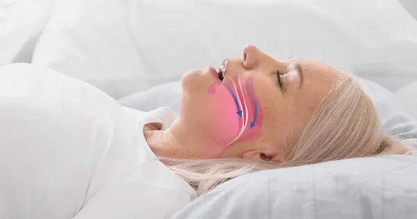 L'apnea notturna aumenta il rischio di demenza nelle donne anziane
