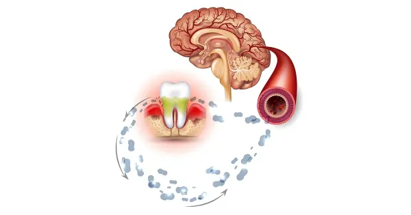 Come il microbioma orale influenza il rischio di demenza